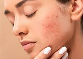 Dark Spots Treatments