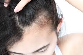 Hair Regrowth